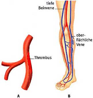 Thrombose ursachen