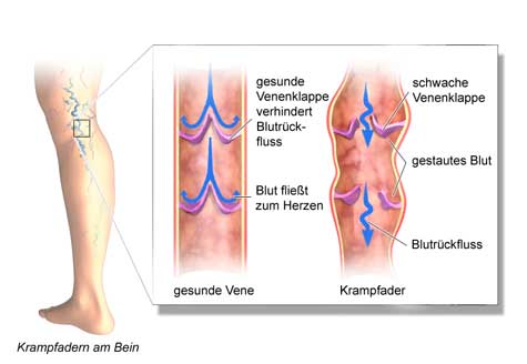 krampfadern bein